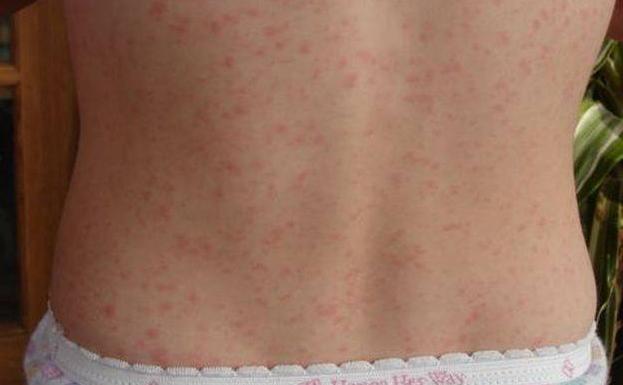 fiebre y sarpullido en todo el cuerpo